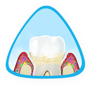 Phases of gum inflammation: Healthy gums, gingivitis, advanced periodontitis Phases of gum inflammation: Healthy gums, gingivitis, advanced periodontitis