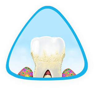 Advanced periodontitis Advanced periodontitis